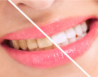Woman perfect whiten teeth