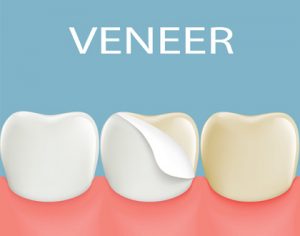 Dental veneers on a human tooth.