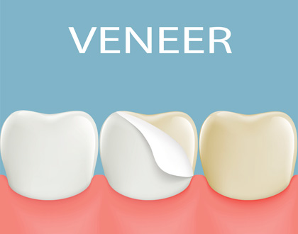 Dental veneers on a human tooth.