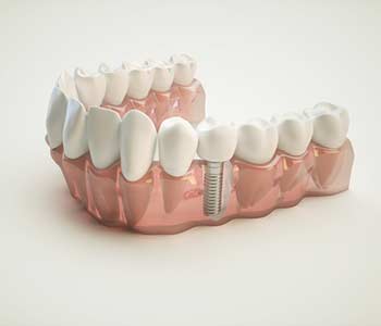 Dental Implants for Missing Teeth in Scottsdale AZ area
