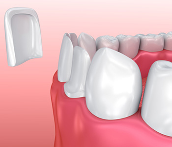 Cosmetic Teeth Veneers Scottsdale AZ area