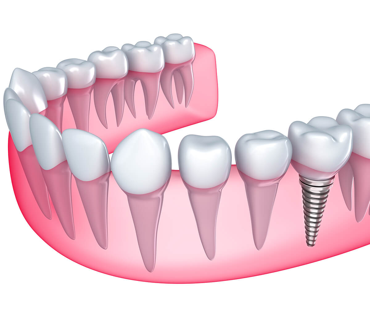 Where Can I Find a Dentist, Who Specializes in Dental Implants near Scottsdale, AZ Area?