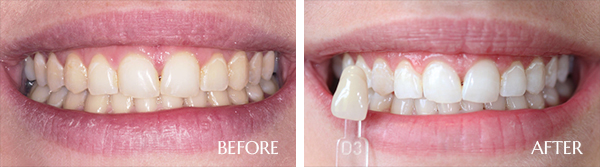 Before and After image of Teeth Whitening for Sensitive Teeth in Scottsdale AZ Area