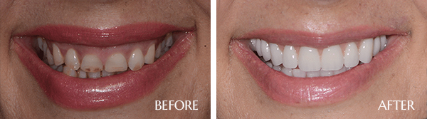 Dental Implants Before After Results