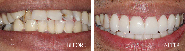 Porcelain veneers Before After Results
