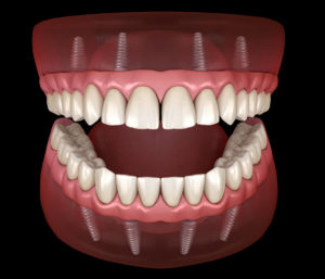 All-On-4 Implants for Teeth Improve Oral Health in Scottsdale AZ Area