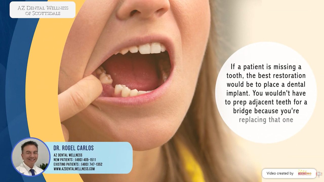 Dental Implants at AZ Dental Wellness - Dr. Rogel Carlos