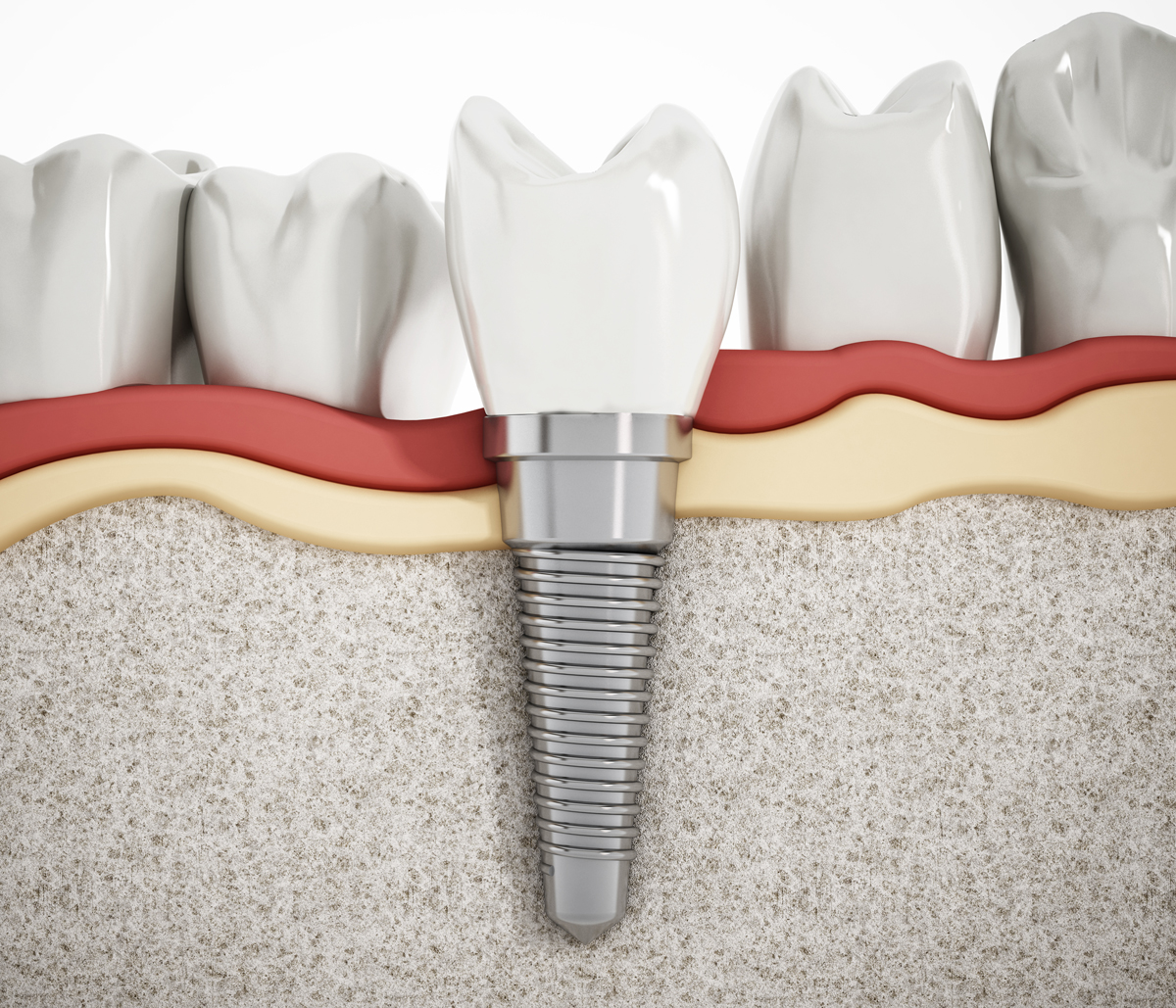 Dental Implant Surgery Near Me In Scottsdale AZ